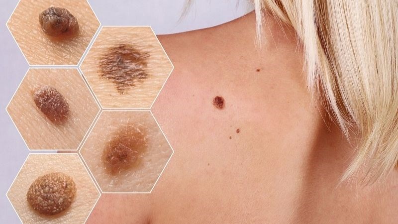 Có thể phát hiện sớm ung thư hắc tố bằng những thay đổi bất thường trên da