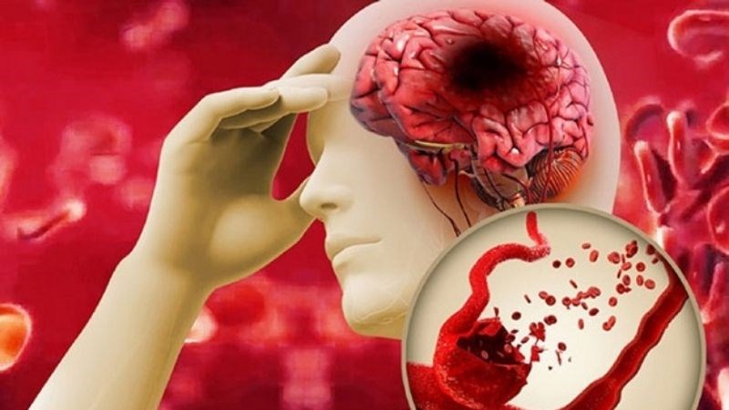 Tim đập nhanh có thể gây nên tình trạng đột quỵ 