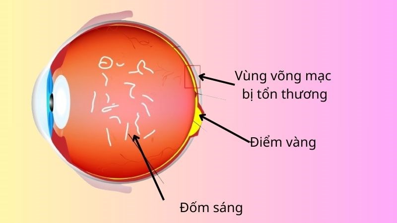 Võng mạc bị tổn thương là nguyên nhân gây nên tình trạng mắt nhìn thấy đốm sáng