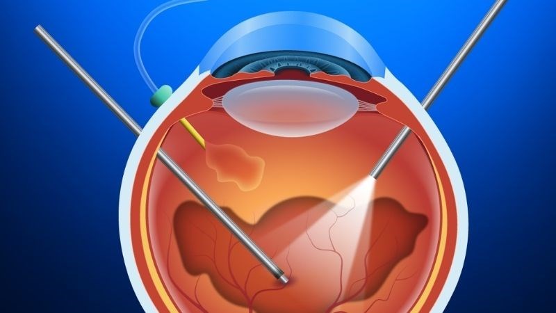 Vá phần võng mạc bị bong có thể cải thiện thị lực cho người bệnh