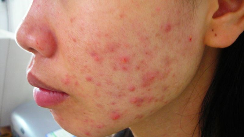 Các loại mặt nạ chứa retinol hoặc axit có thể gây kích ứng da