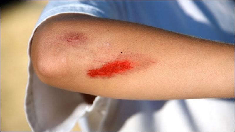 Vi khuẩn B.pseudomallei có thể xâm nhập vào cơ thể qua những vết thương hở trên da