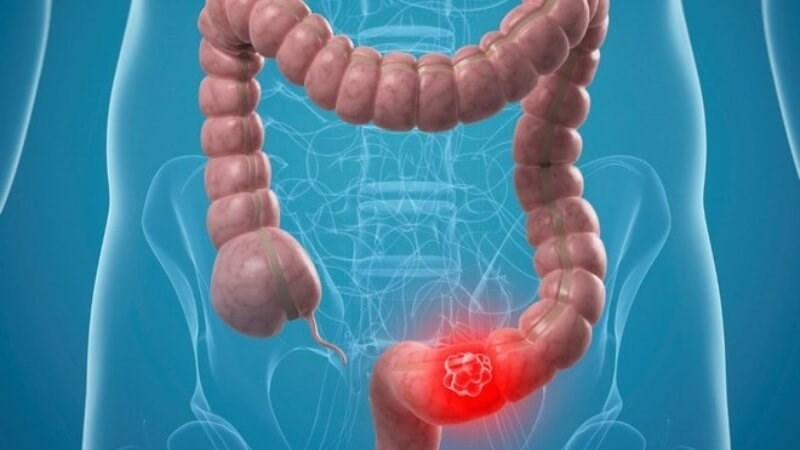 Nấm hầu thủ giúp phòng ngừa và cải thiện triệu chứng bệnh Crohn