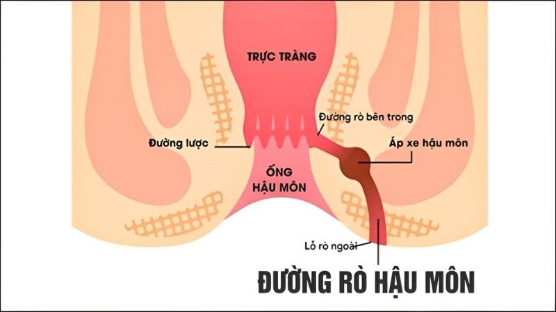 Bệnh rò hậu môn thường xuất hiện các lỗ rò, đường rò chảy dịch tiết ra bên ngoài