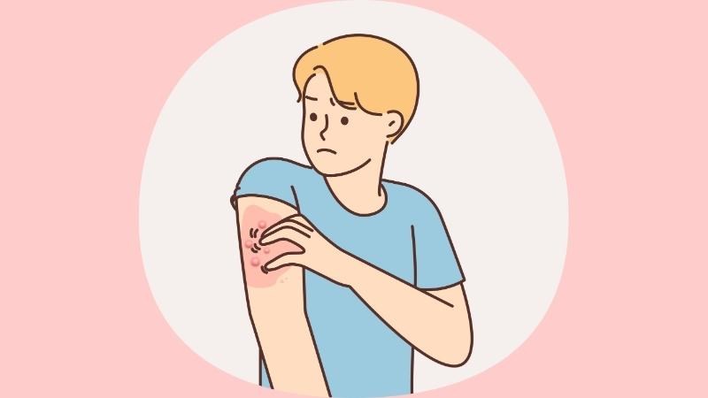 Người bệnh bị nấm da có thể có các biểu hiện như mảng nấm trên da và ngứa Người bệnh bị nấm da có thể có các biểu hiện như mảng nấm trên da và ngứa