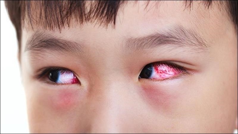 Đau mắt đỏ gây viêm kết mạc làm mạch máu ở đây giãn ra và khiến mắt bị đỏ. Đau mắt đỏ gây viêm kết mạc làm mạch máu ở đây giãn ra và khiến mắt bị đỏ.