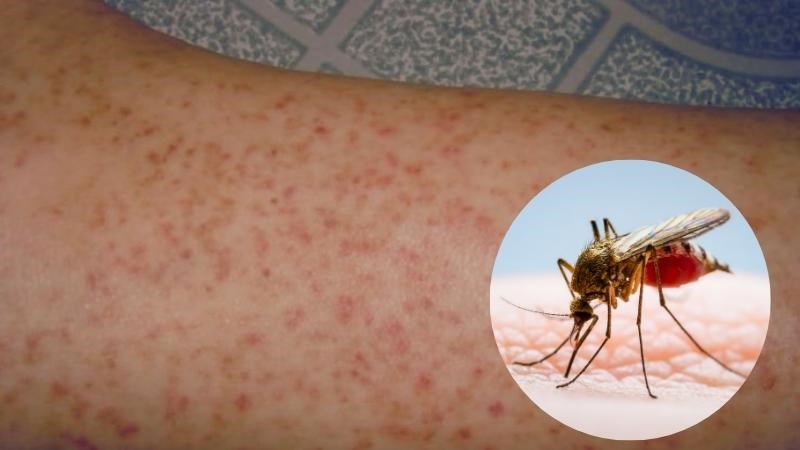 Người bệnh bị sốt xuất huyết thường nổi các chấm xuất huyết dưới da Người bệnh bị sốt xuất huyết thường nổi các chấm xuất huyết dưới da