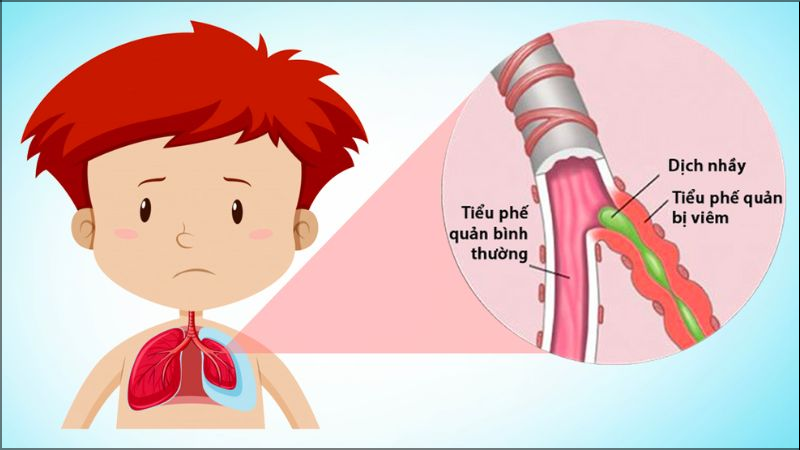 Viêm tiểu phế quản là bệnh lý nhiễm trùng đường hô hấp dưới cấp tính do vi-rút gây ra