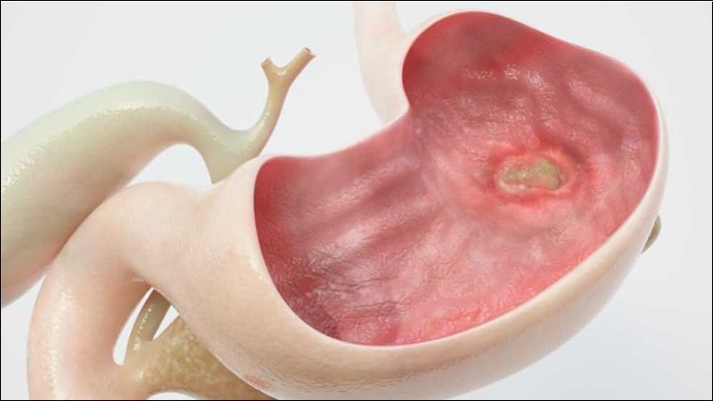 Cắt dạ dày cũng được chỉ định trong các trường hợp viêm loét dạ dày nghiêm trọng
