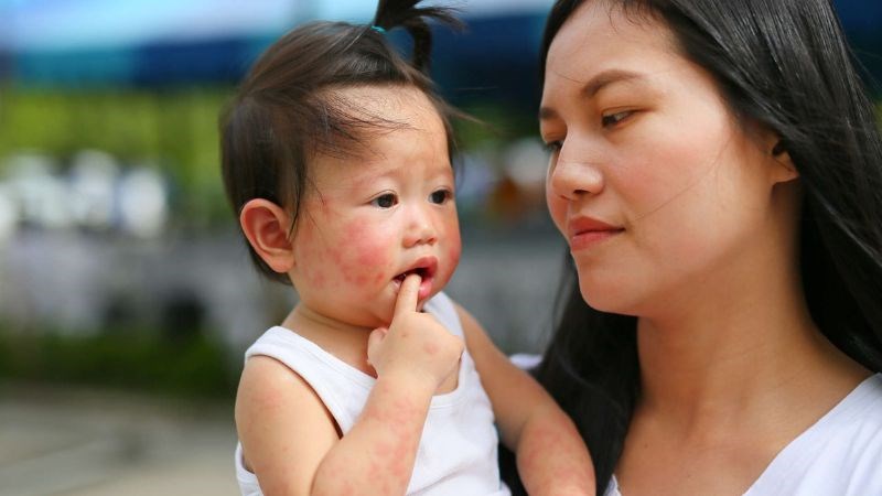 Dị ứng thời tiết thường xuất hiện đột ngột khi cơ thể tiếp xúc với dị nguyên Dị ứng thời tiết thường xuất hiện đột ngột khi cơ thể tiếp xúc với dị nguyên