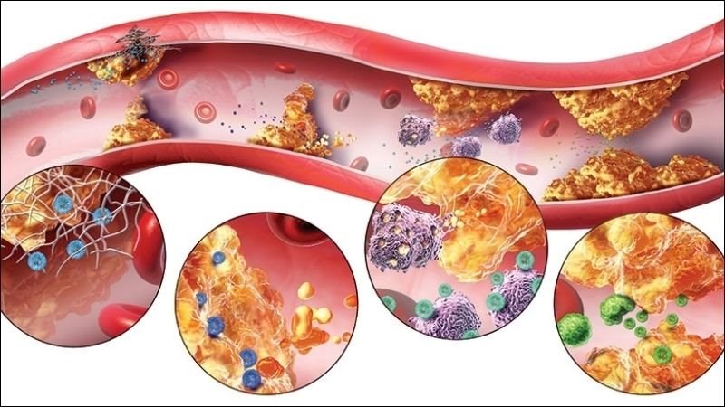 Rối loạn mỡ máu là nguyên nhân hàng đầu gây bệnh lý tim mạch