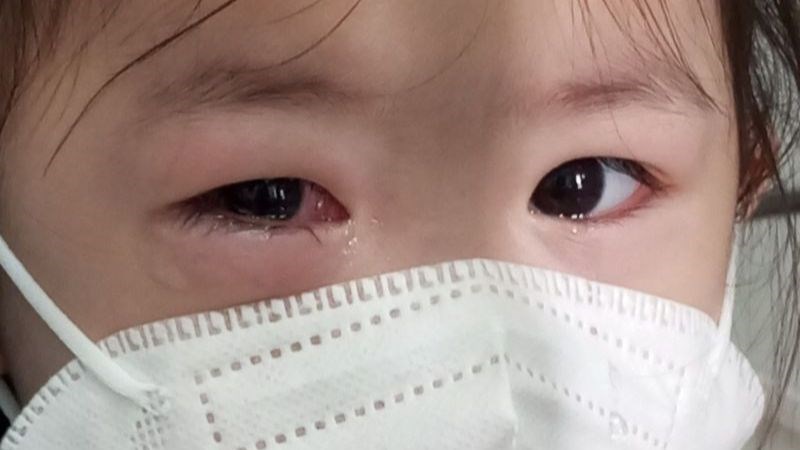 Đau mắt đỏ hay còn gọi là viêm kết mạc