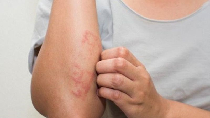 Dị ứng da hay còn được gọi là dị ứng thời tiết
