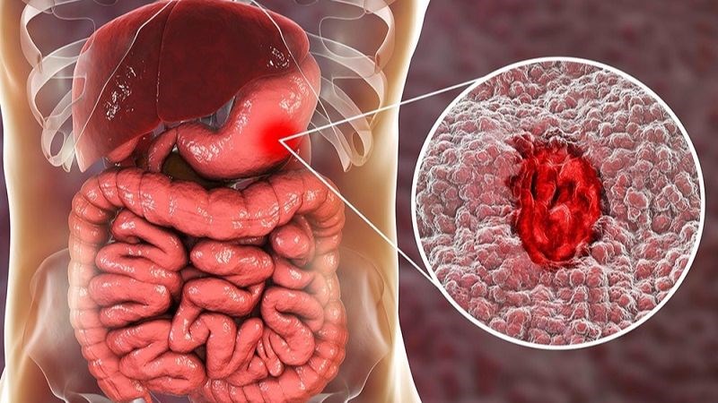 Người bị viêm loét đường tiêu hóa không nên ăn chuối khi bụng đói
