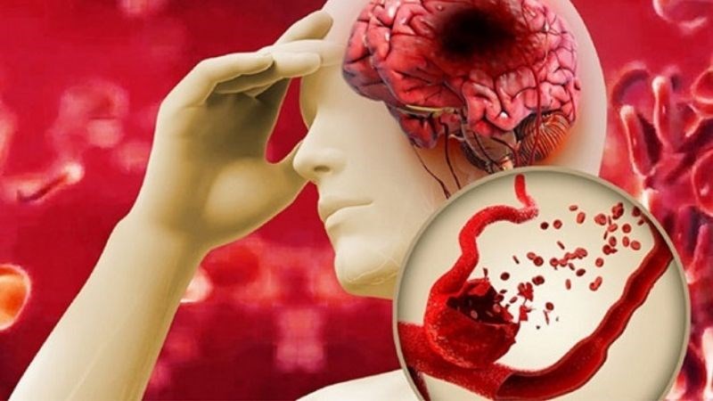 Tai biến mạch máu não là một trong những biến chứng của stress
