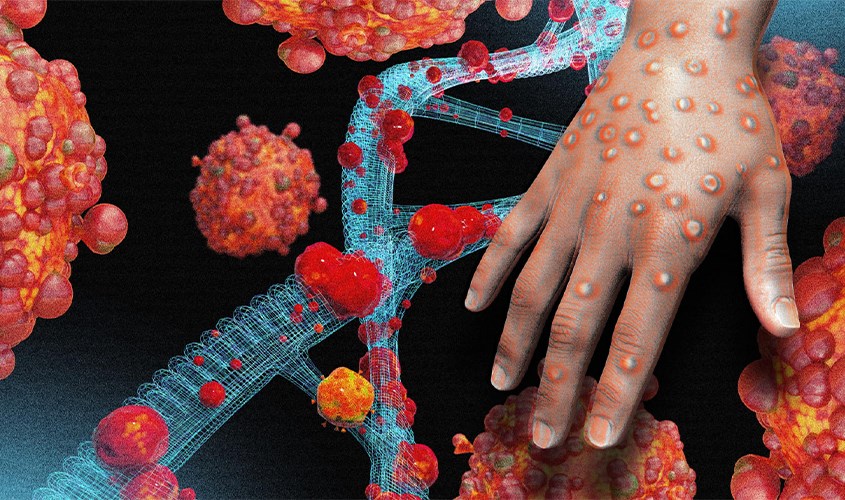 Bệnh đậu mùa khỉ là bệnh truyền nhiễm do Orthopoxvirus gây ra