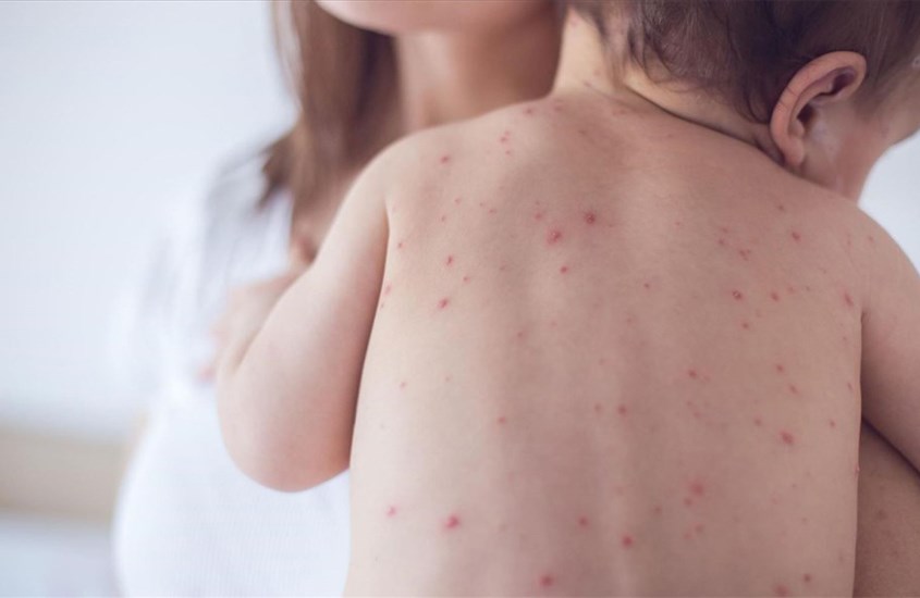 Trẻ nhỏ là dễ bị bệnh đậu mùa khỉ nặng hơn so với trẻ vị thành nhiên và người trưởng thành