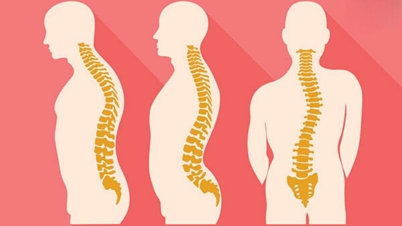 Cong vẹo cột sống là tình trạng cột sống không ở trạng thái sinh lý bình thường