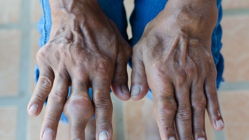 Hạt tophi trong bệnh gout có thể gây biến dạng khớp