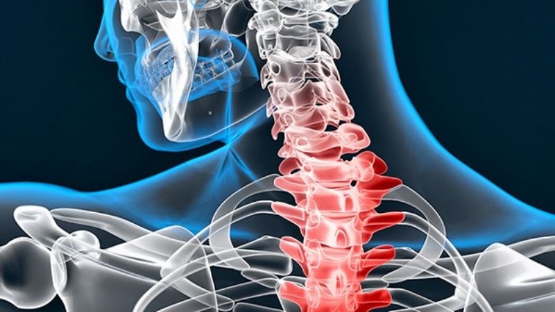 Gai cột sống là tình trạng mỏm xương nhô ra từ cột sống