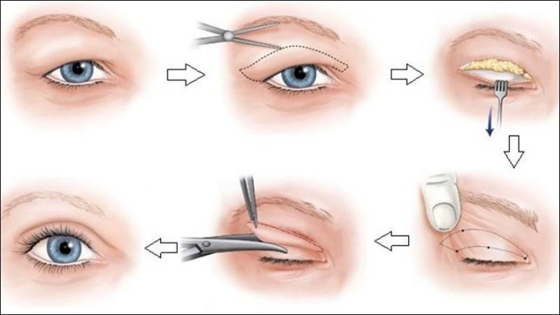 Phẫu thuật cắt mí mắt sẽ ít nhiều gây tổn thương mắt của bạn