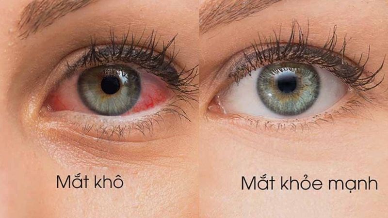 Thuốc nhỏ mắt vitamin A có hiệu quả trong điều trị khô mắt Thuốc nhỏ mắt vitamin A có hiệu quả trong điều trị khô mắt