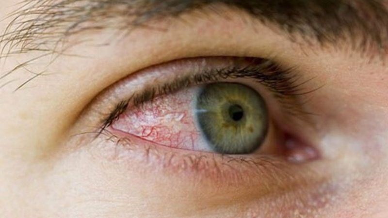 Vitamin A có hiệu quả trong điều trị viêm kết mạc Vitamin A có hiệu quả trong điều trị viêm kết mạc