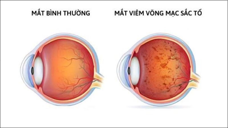 Vitamin A kết hợp với lutein có thể hỗ trợ thị lực ở người bị viêm võng mạc sắc tố Vitamin A kết hợp với lutein có thể hỗ trợ thị lực ở người bị viêm võng mạc sắc tố