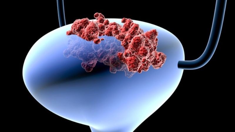 Ung thư bàng quang là sự tăng sinh bất thường các tế bào ở bàng quang