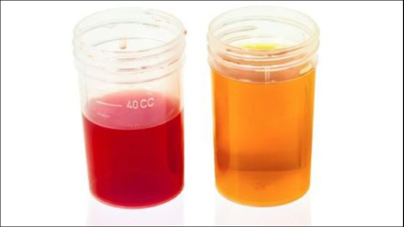Tiểu máu là một trong những dấu hiệu của ung thư thận