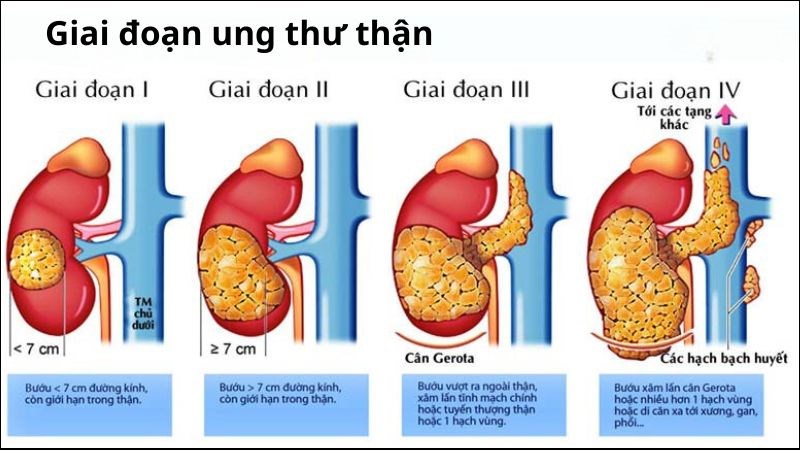 Ung thư thận có 4 giai đoạn phát triển