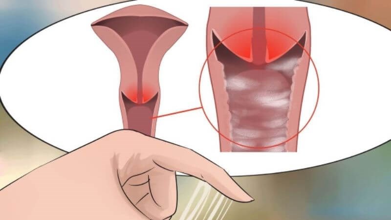 Viêm âm đạo là tình trạng âm đạo bị các tác nhân gây hại tấn công gây viêm