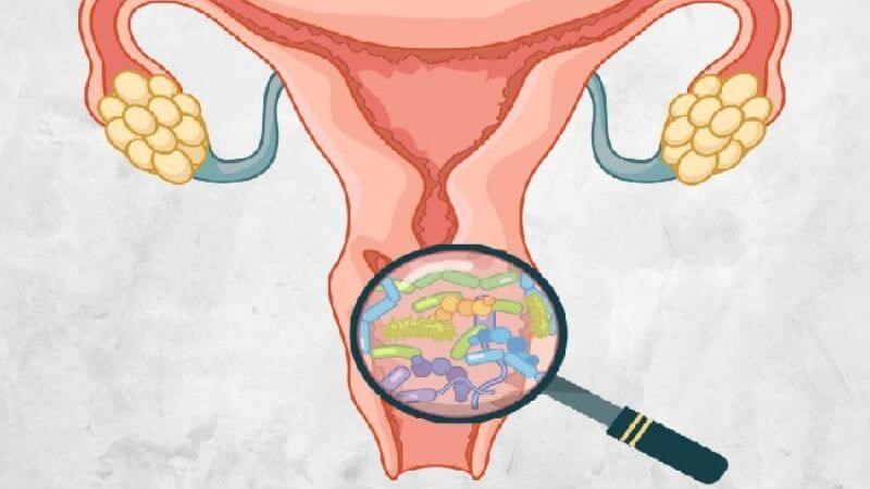 Viêm âm đạo do vi khuẩn là căn nguyên hay gặp nhất