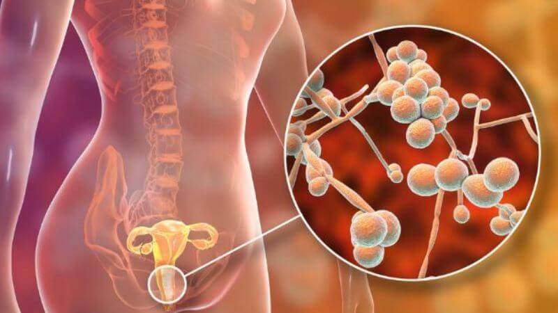 Viêm âm đạo do nấm thường gặp ở bệnh nhân suy giảm miễn dịch