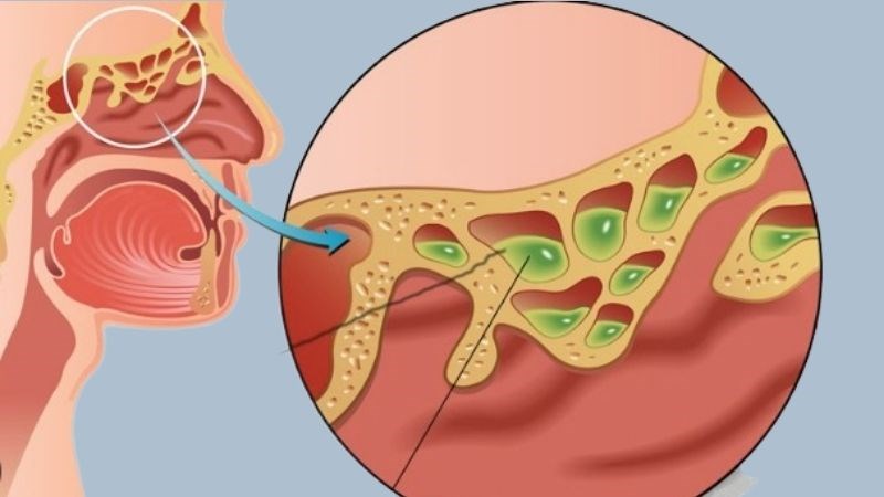 Nghẹt mũi là tình trạng xuất hiện chất nhầy gây tắc đường thở ở mũi