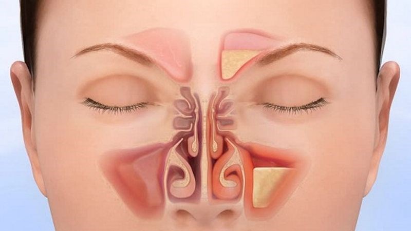 Viêm xoang có thể dẫn tới tình trạng nghẹt mũi