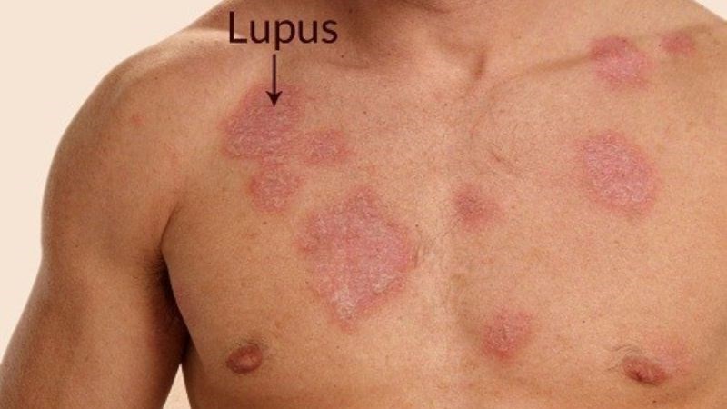Lupus ban đỏ được cho là yếu tố nguy cơ của viêm đa cơ