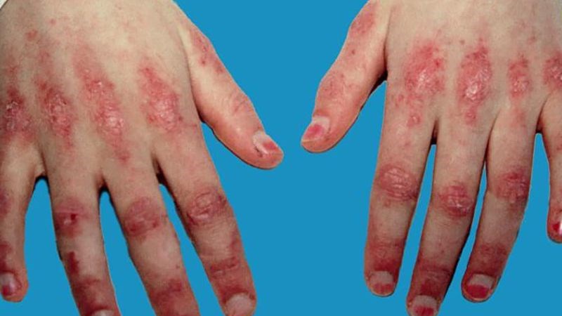 Viêm da cơ và viêm đa cơ đều được gọi chung với tên gọi là viêm cơ tự miễn Viêm da cơ và viêm đa cơ đều được gọi chung với tên gọi là viêm cơ tự miễn