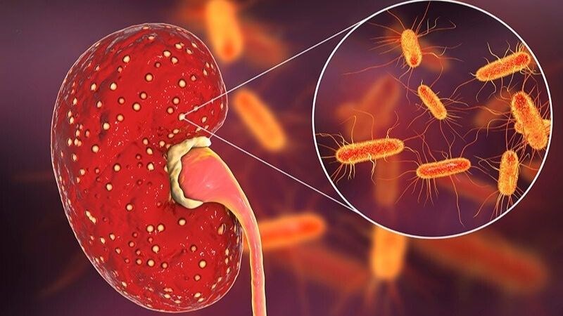 Vi khuẩn tấn công vào nhu mô thận gây nên tình trạng viêm thận bể thận
