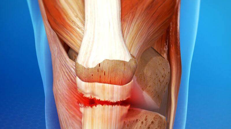 Viêm gân nếu không được điều trị đúng cách có thể dẫn tới đứt gân