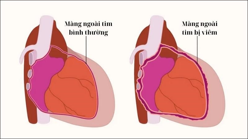 Viêm màng ngoài tim chủ yếu liên quan đến sự thay đổi khoang màng ngoài tim