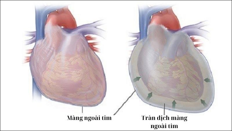 Viêm màng ngoài tim có thể dẫn tới tràn dịch màng ngoài tim