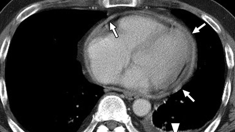CT-scan lồng ngực được dùng để chẩn đoán viêm màng ngoài tim
