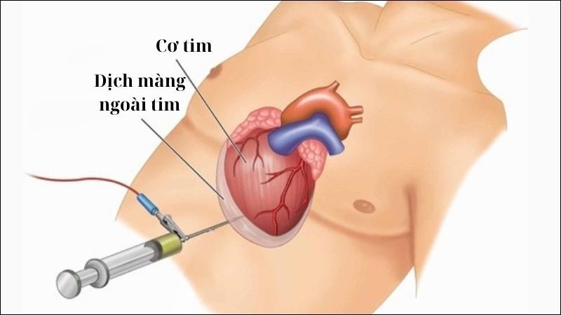 Chọc dịch màng ngoài tim được chỉ định khi có tràn dịch màng ngoài tim