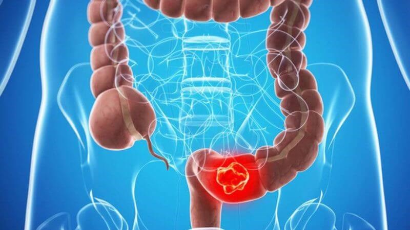 Viêm ruột có thể chuyển thành ung thư đại tràng