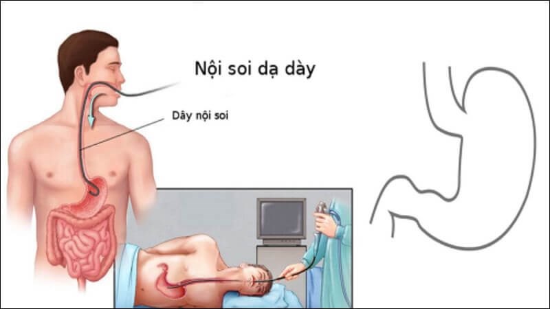 Nội soi dạ dày - thực quản giúp quan sát niêm mạc thực quản