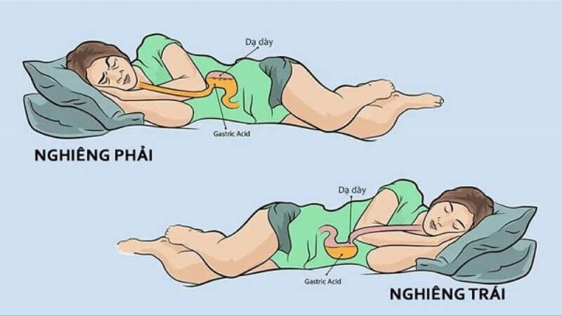 Nên nằm nghiêng sang trái để tránh axit trào ngược thực quản