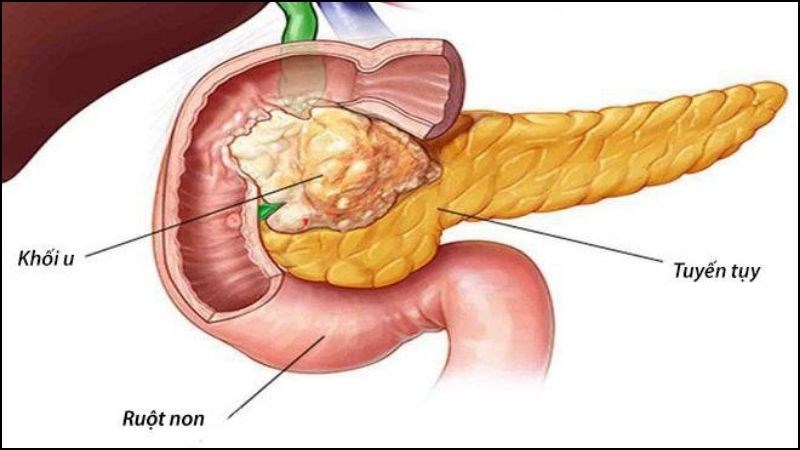 Viêm tụy mãn có thể gây nên ung thư tụy