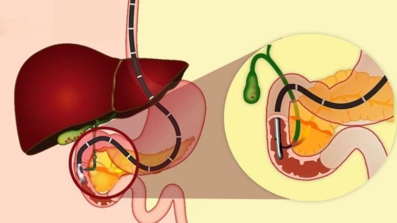 Phẫu thuật nội soi là phương pháp thường dùng trong điều trị viêm tụy mạn