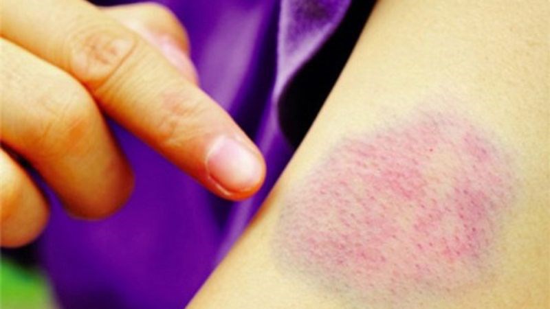 Bệnh gây nên tình trạng da dễ bầm tím